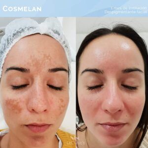 cosmelan-AD