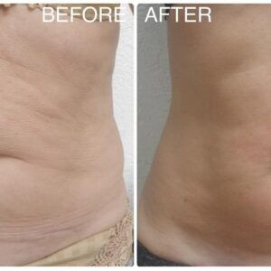 endymed abdomen antes y después