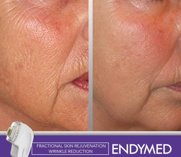 ENDYMED Cara Antes y Después