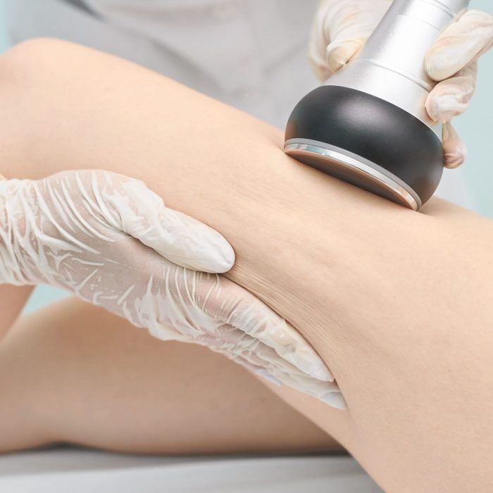 criolipolisis