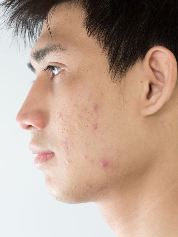 facualACNE
